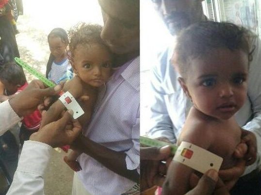 malnutrition au Yémen