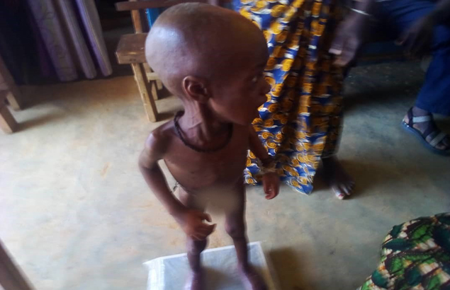 malnutrition in Democratic Republic of Congo